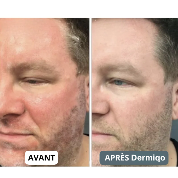 SensiCalma® Duo+ ⎜ Barbe et cuir chevelu apaisés